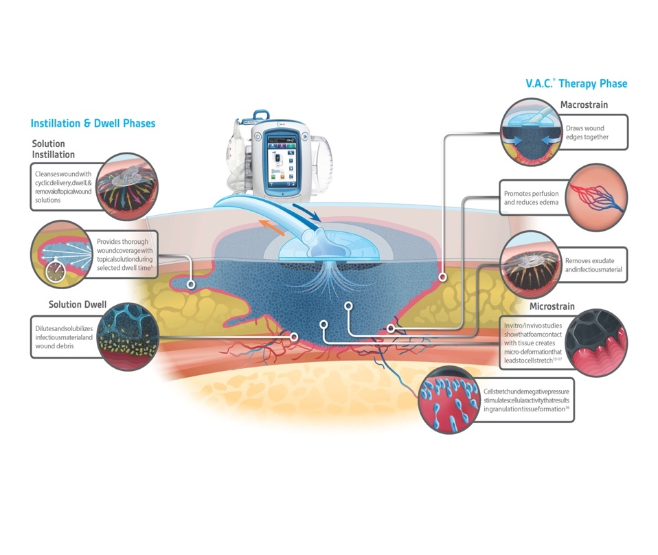 为什么负压引流再谈负压封闭引流技术_https://www.jmylbn.com_新闻资讯_第11张