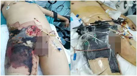 为什么负压引流再谈负压封闭引流技术_https://www.jmylbn.com_新闻资讯_第4张