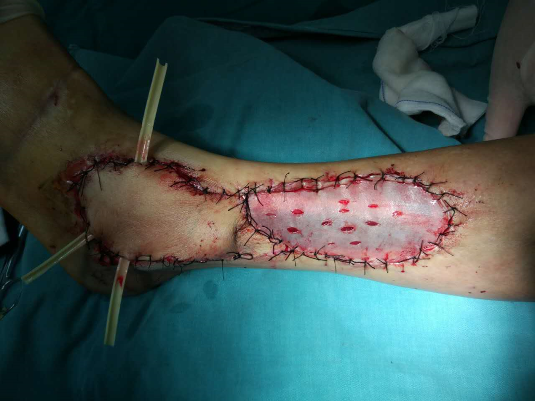 为什么负压引流再谈负压封闭引流技术_https://www.jmylbn.com_新闻资讯_第5张