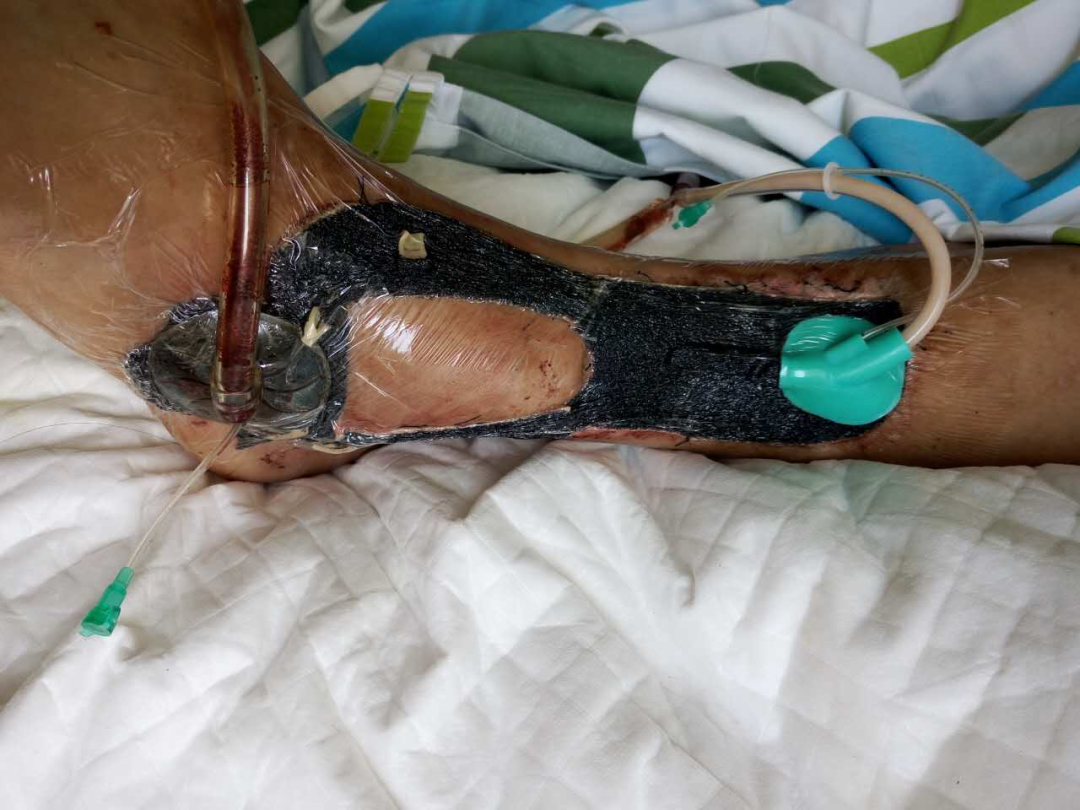 为什么负压引流再谈负压封闭引流技术_https://www.jmylbn.com_新闻资讯_第6张