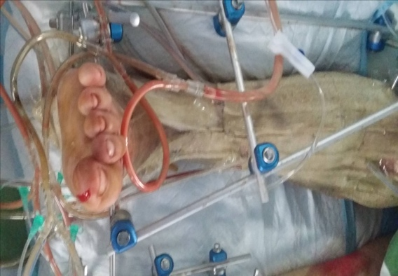 为什么负压引流再谈负压封闭引流技术_https://www.jmylbn.com_新闻资讯_第10张