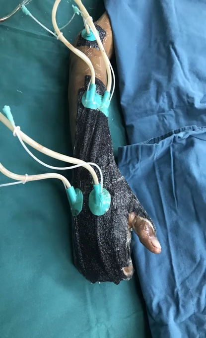 为什么负压引流再谈负压封闭引流技术_https://www.jmylbn.com_新闻资讯_第3张