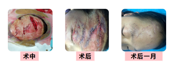 伤口怎么用医用胶无痕急诊外科-医用胶_https://www.jmylbn.com_新闻资讯_第4张