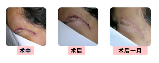 伤口怎么用医用胶无痕急诊外科-医用胶_https://www.jmylbn.com_新闻资讯_第3张