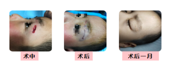 伤口怎么用医用胶无痕急诊外科-医用胶_https://www.jmylbn.com_新闻资讯_第2张