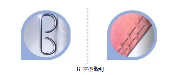 医疗吻合器是什么医疗耗材兵器谱之钩篇---吻合器_https://www.jmylbn.com_新闻资讯_第18张