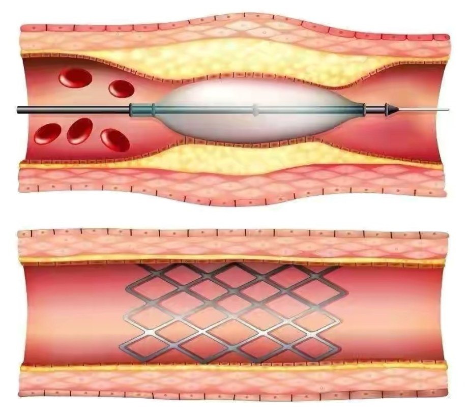 医疗耗材做什么好原创科普好文｜医疗耗材兵器谱之介入球囊_https://www.jmylbn.com_新闻资讯_第18张