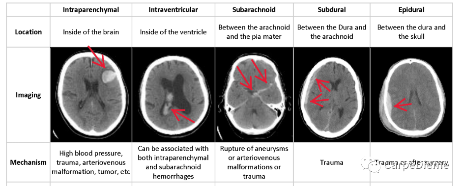 实习笔记颅内出血ct影像呈现如何快速区分不同类型脑出血 全网搜