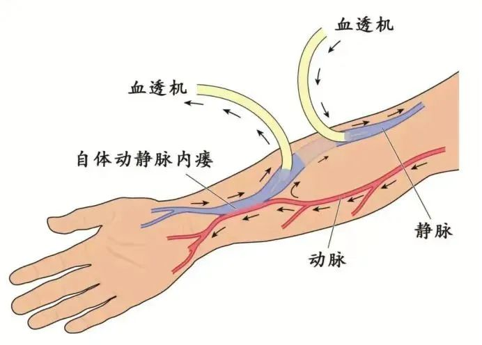 无菌纱块怎么使用透析过程中内瘘穿刺针眼渗血的处理方法_https://www.jmylbn.com_新闻资讯_第3张