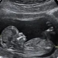 眼科ab超单怎么看准妈妈们看过来，教您如何看B超单_https://www.jmylbn.com_新闻资讯_第3张