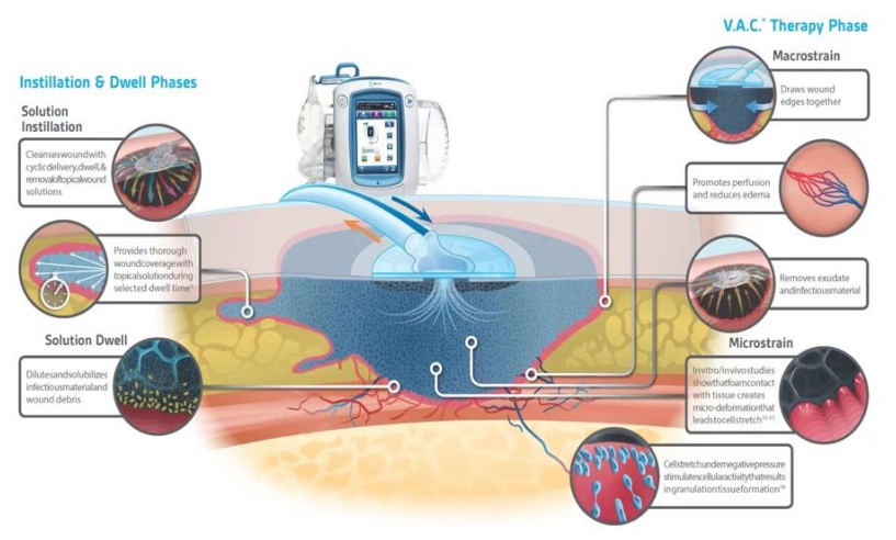 vsd引流器怎么连接创面负压封闭引流技术（VSD），让患者创面更快痊愈！_https://www.jmylbn.com_新闻资讯_第1张