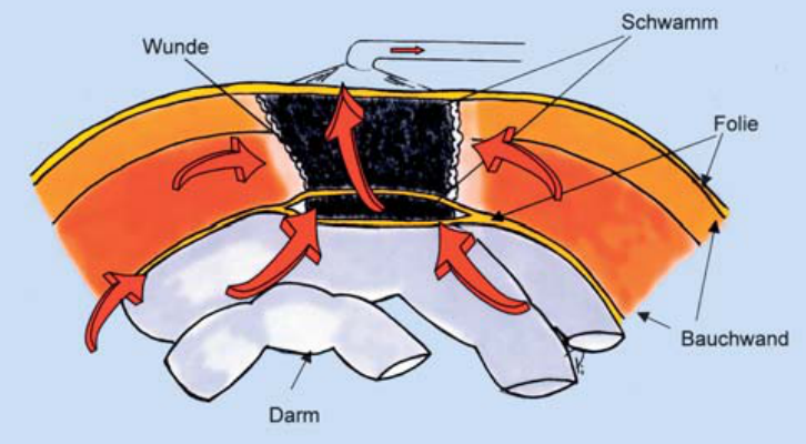 vsd引流器怎么连接创面负压封闭引流技术（VSD），让患者创面更快痊愈！_https://www.jmylbn.com_新闻资讯_第2张