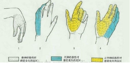 手麻、腿麻、麻痛…这可是脑梗、肿 瘤的前兆！别大意～