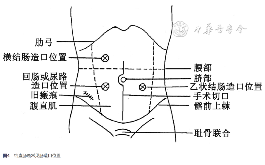 放疗体膜是什么中国结直肠癌诊疗规范（2023年版）_https://www.jmylbn.com_新闻资讯_第9张