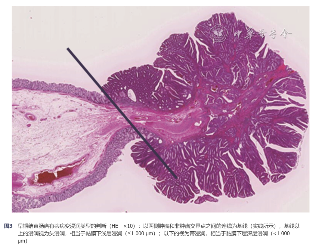 放疗体膜是什么中国结直肠癌诊疗规范（2023年版）_https://www.jmylbn.com_新闻资讯_第3张