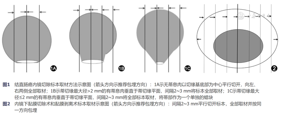 放疗体膜是什么中国结直肠癌诊疗规范（2023年版）_https://www.jmylbn.com_新闻资讯_第2张