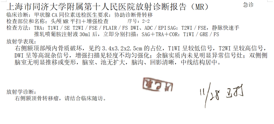 骨密度影是什么甲状腺癌全身多发转移病例（肺 骨 脑）_https://www.jmylbn.com_新闻资讯_第4张