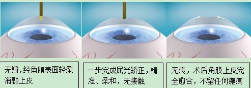 角膜屈光手术的发展史