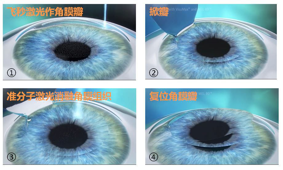 角膜屈光手术的发展史