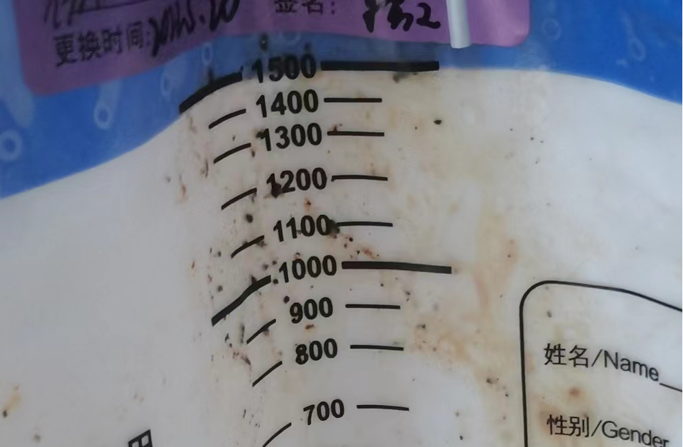 引流器排泄怎么用一根“管子”能解黄！｜ 经皮肝穿刺胆道引流术轻松解决胆汁排泄障碍_https://www.jmylbn.com_新闻资讯_第7张