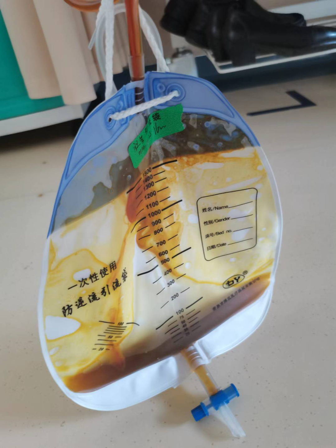 引流器排泄怎么用一根“管子”能解黄！｜ 经皮肝穿刺胆道引流术轻松解决胆汁排泄障碍_https://www.jmylbn.com_新闻资讯_第5张