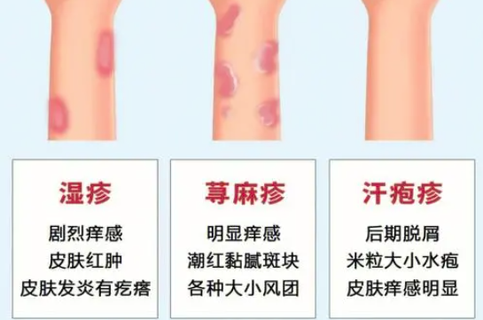 东莞有专门的皮肤医院吗？手指脱皮咋回事？湿疹、手癣、汗疱疹如何区分？东莞哪里看皮肤科比较好的医院？