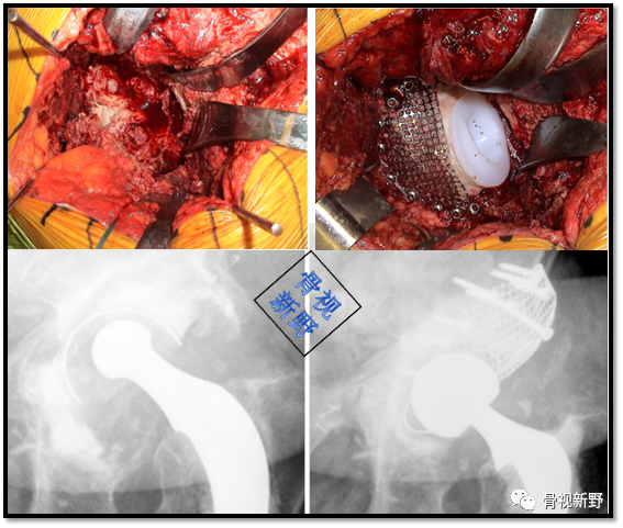 关于髋臼翻修的“杯中杯”技术,你知道多少？