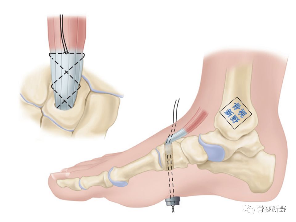 为什么用钢丝缝线图解︱腱-骨止点重建技术大全_https://www.jmylbn.com_新闻资讯_第6张