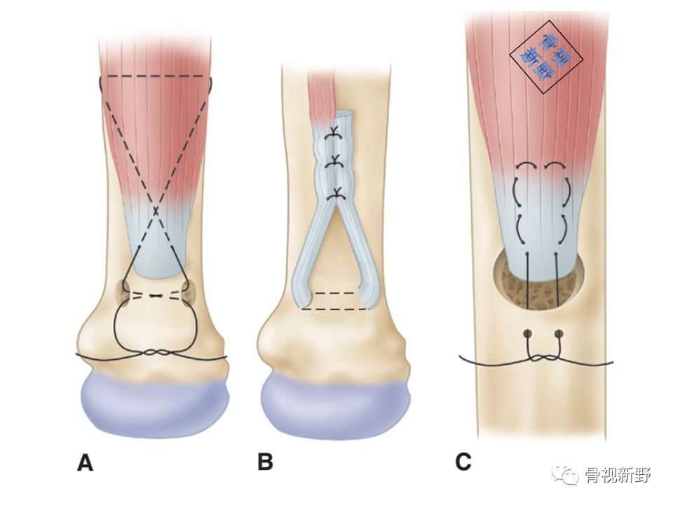 为什么用钢丝缝线图解︱腱-骨止点重建技术大全_https://www.jmylbn.com_新闻资讯_第4张
