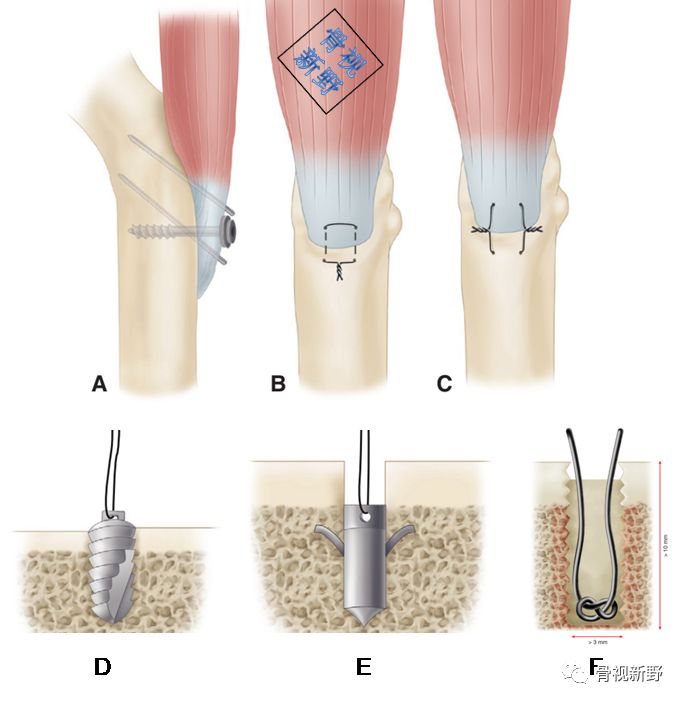 为什么用钢丝缝线图解︱腱-骨止点重建技术大全_https://www.jmylbn.com_新闻资讯_第2张