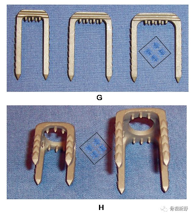 为什么用钢丝缝线图解︱腱-骨止点重建技术大全_https://www.jmylbn.com_新闻资讯_第3张