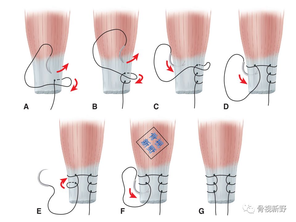 为什么用钢丝缝线图解︱腱-骨止点重建技术大全_https://www.jmylbn.com_新闻资讯_第5张