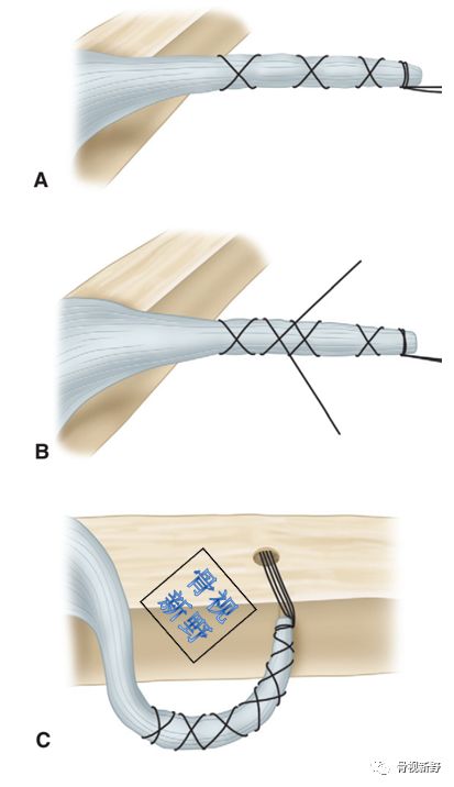为什么用钢丝缝线图解︱腱-骨止点重建技术大全_https://www.jmylbn.com_新闻资讯_第7张