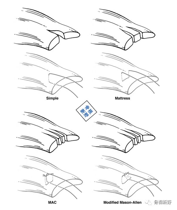 为什么用钢丝缝线图解︱腱-骨止点重建技术大全_https://www.jmylbn.com_新闻资讯_第9张