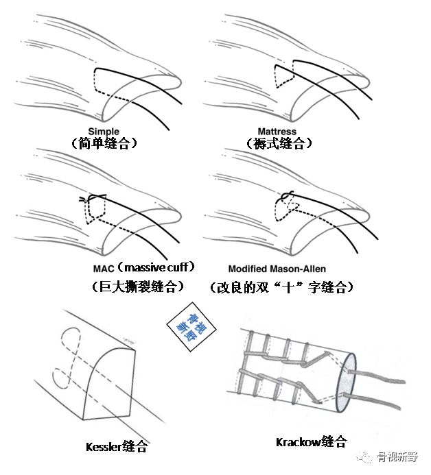 常見的肌腱縫合術式腱—骨縫合固定01