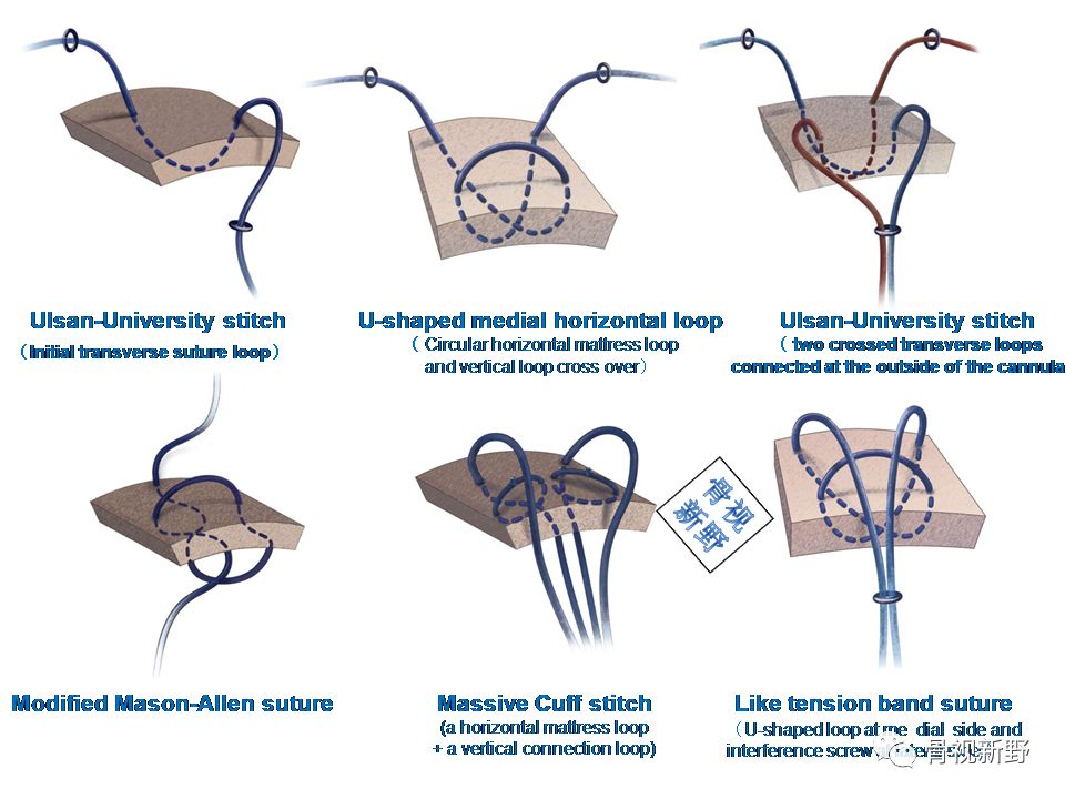 为什么用钢丝缝线图解︱腱-骨止点重建技术大全_https://www.jmylbn.com_新闻资讯_第8张