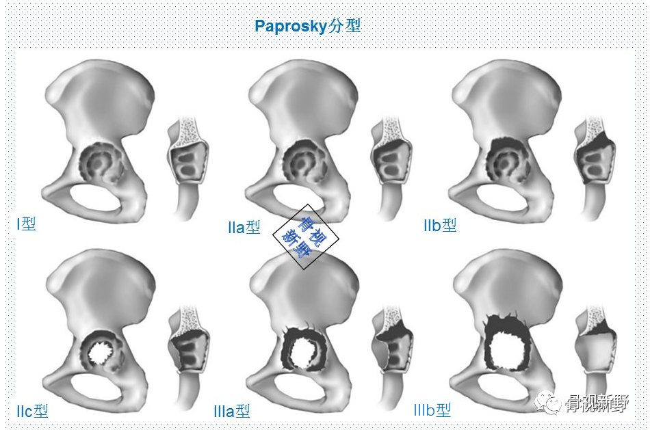关于髋臼翻修的“杯中杯”技术,你知道多少？