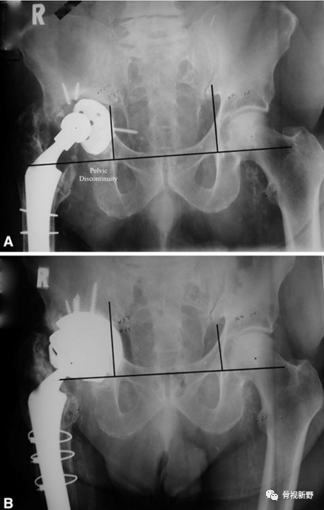 关于髋臼翻修的“杯中杯”技术,你知道多少？