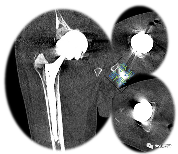 关于髋臼翻修的“杯中杯”技术,你知道多少？