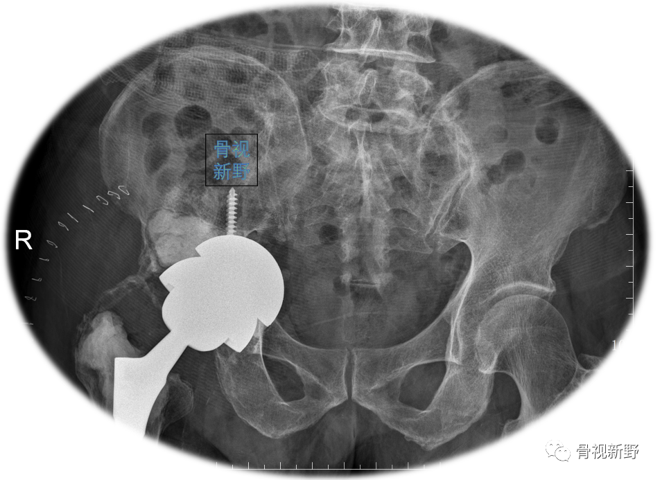 关于髋臼翻修的“杯中杯”技术,你知道多少？