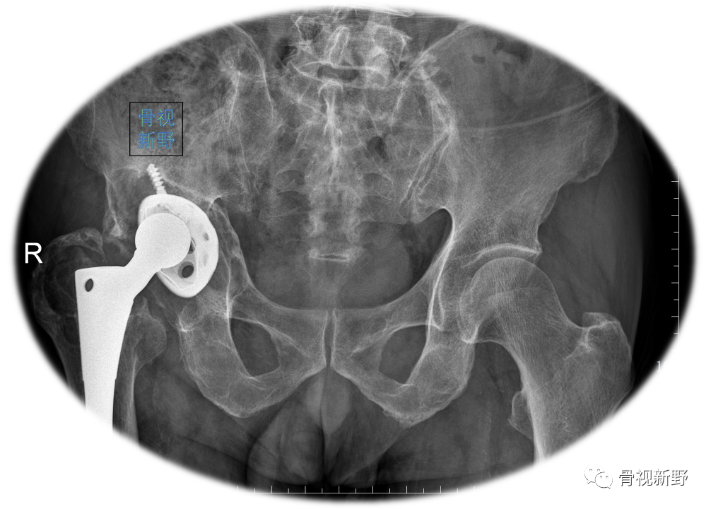 关于髋臼翻修的“杯中杯”技术,你知道多少？