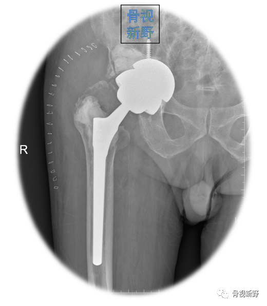 关于髋臼翻修的“杯中杯”技术,你知道多少？
