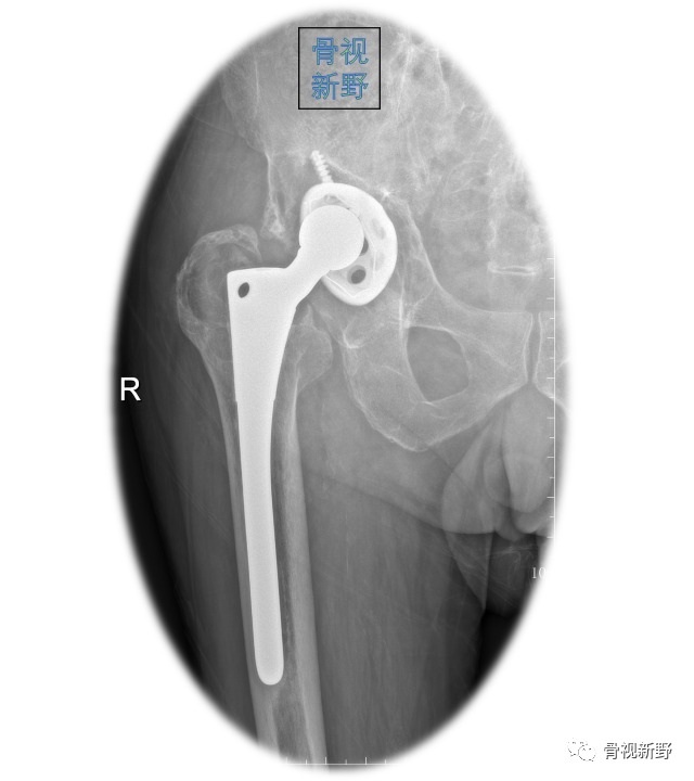 关于髋臼翻修的“杯中杯”技术,你知道多少？