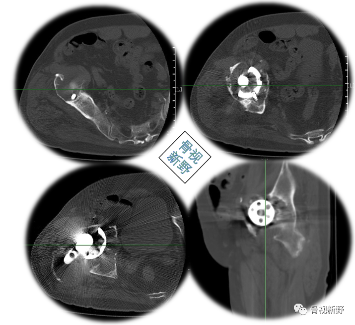 关于髋臼翻修的“杯中杯”技术,你知道多少？