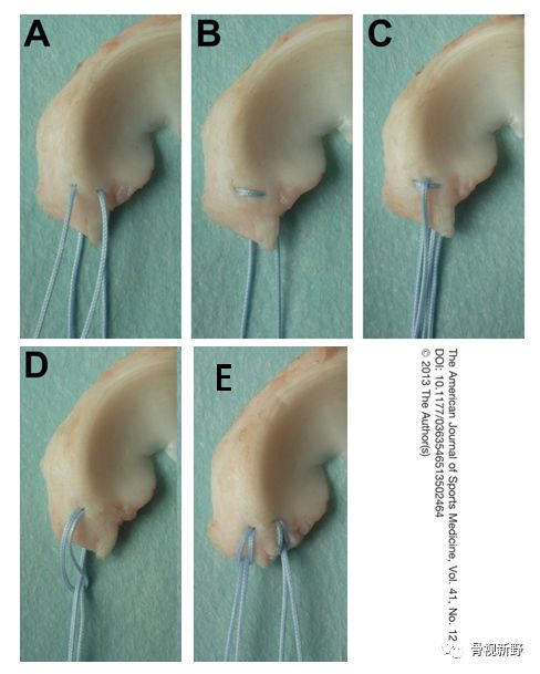 为什么用钢丝缝线图解︱腱-骨止点重建技术大全_https://www.jmylbn.com_新闻资讯_第14张