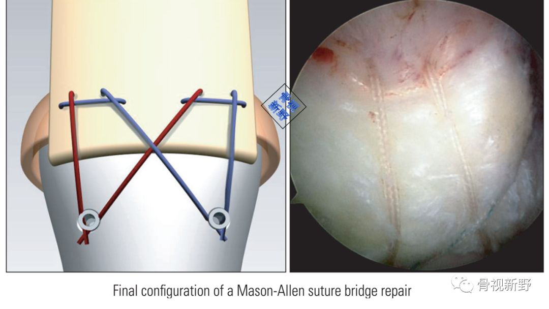 为什么用钢丝缝线图解︱腱-骨止点重建技术大全_https://www.jmylbn.com_新闻资讯_第10张