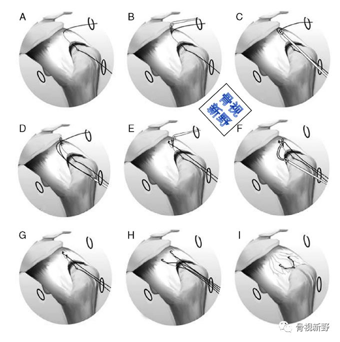 为什么用钢丝缝线图解︱腱-骨止点重建技术大全_https://www.jmylbn.com_新闻资讯_第12张