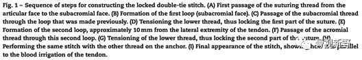为什么用钢丝缝线图解︱腱-骨止点重建技术大全_https://www.jmylbn.com_新闻资讯_第13张