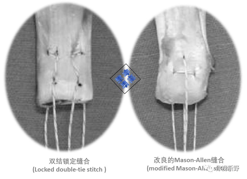 为什么用钢丝缝线图解︱腱-骨止点重建技术大全_https://www.jmylbn.com_新闻资讯_第11张