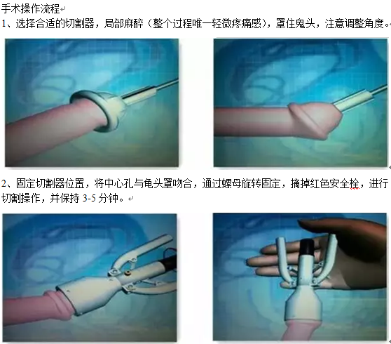 【两性】为了满足女朋友，我在丁丁上割了一刀（组图） - 6